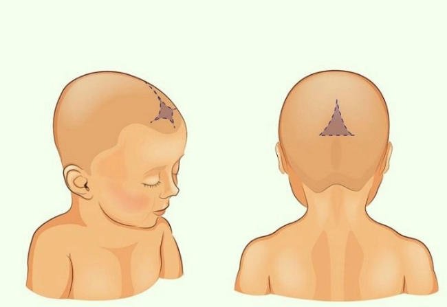 Hình ảnh thóp trẻ sơ sinh bình thường 1