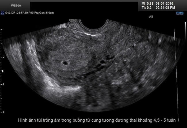 Hình ảnh túi trống âm trong buồng tử cung tương đương thai khoảng 4.5 - 5 tuần tuổi