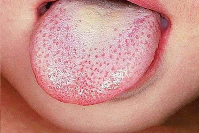 Hình nấm miệng giả mạc gây phù nề lưỡi, vòm miệng, má