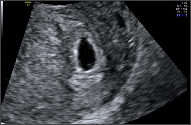 Khi siêu âm ở tuần thứ 5 của thai kỳ, bác sĩ có thể thấy được túi thai