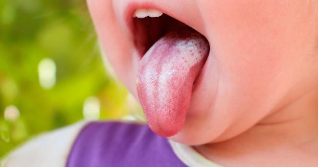 Có những thuốc bôi nấm miệng nào dành riêng cho trẻ sơ sinh?
