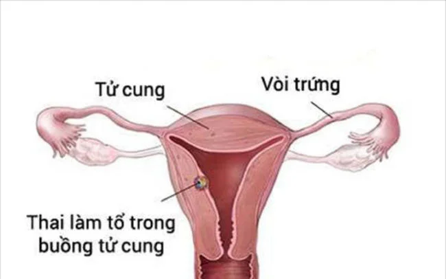 Mang thai ngoài tử cung cần được cấp cứu ngay