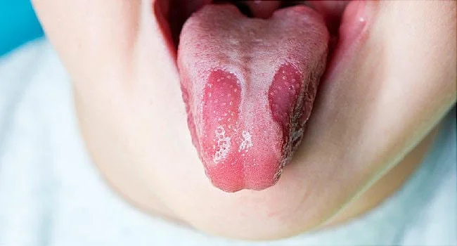 Hình ảnh nấm lưỡi ở trẻ và nguyên nhân, dấu hiệu