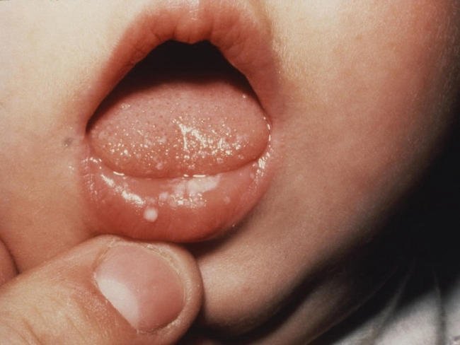 Những triệu chứng của nấm miệng ở trẻ 3 tuổi là gì?
