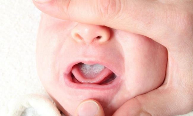 Hình ảnh nấm miệng ở trẻ sơ sinh khiến mẹ rùng mình