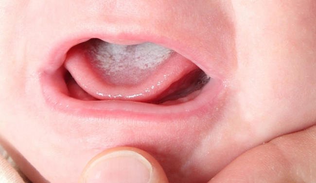 Trẻ sơ sinh có hệ miễn dịch chưa hoàn thiện là đối tượng dễ bị nấm miệng