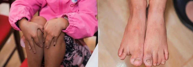Sau khi phát hiện bé Nguyễn Thị Năng bị dị tật dính ngón tay, ngón chân, có thể sửa chữa được, đoàn thiện nguyện đã kết nối bé lên TPHCM để được thăm khám, phẫu thuật