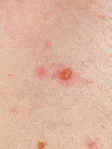 hinh anh cua benh thuy dau giai doan hai 2