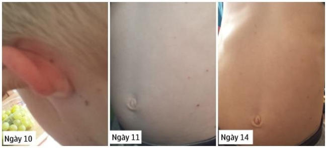 hinh anh tre bi thuy dau giai doan ba 1