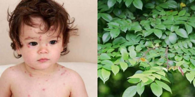 Trẻ bị bệnh thủy đậu tắm lá gì