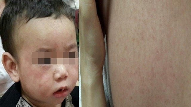 Bệnh sởi ở trẻ em