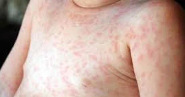 hinh anh benh soi o tre em 3