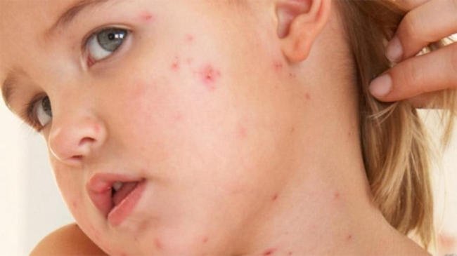 Bệnh Sởi Ở Trẻ Em: Hình Ảnh, Nguyên Nhân Và Dấu Hiệu