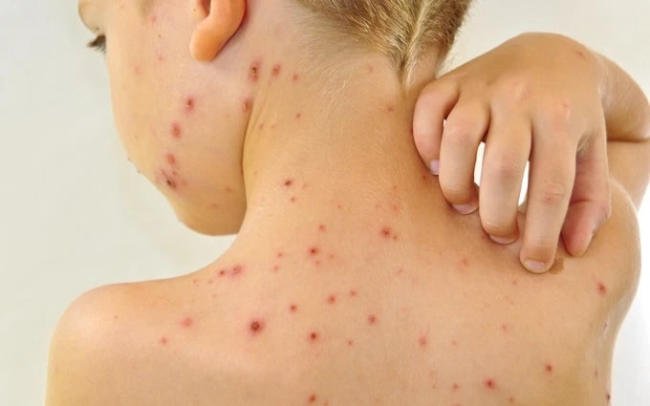 hinh anh benh soi o tre em 6