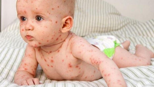 Trẻ bị sởi tắm lá gì