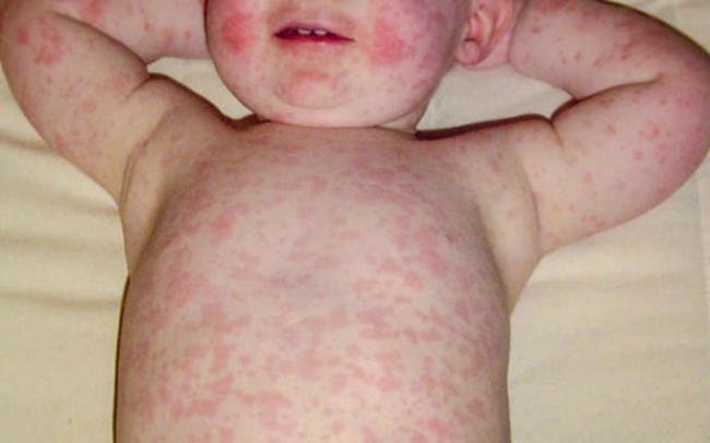 Triệu chứng bệnh Rubella