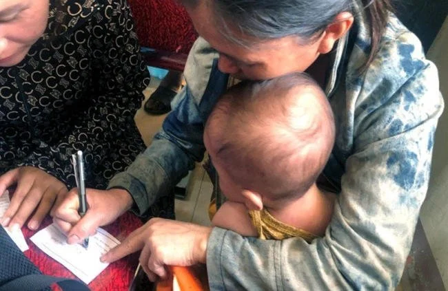 Mái tóc thưa, mỏng và vàng, dáng đầu lồi lõm là biểu hiện lâm sàng của trẻ bị thiếu vi chất dinh dưỡng rất nặng