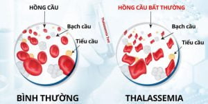 Bệnh Thalassemia ở trẻ em