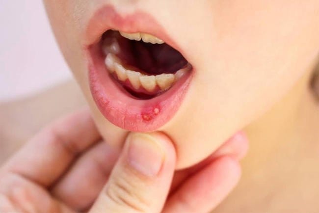 Tìm hiểu về bệnh nhiệt miệng ở trẻ