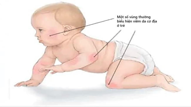 Tìm hiểu bệnh viêm da cơ địa ở trẻ em