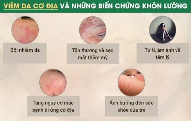 viem da co dia va nhung bien chung khon luong