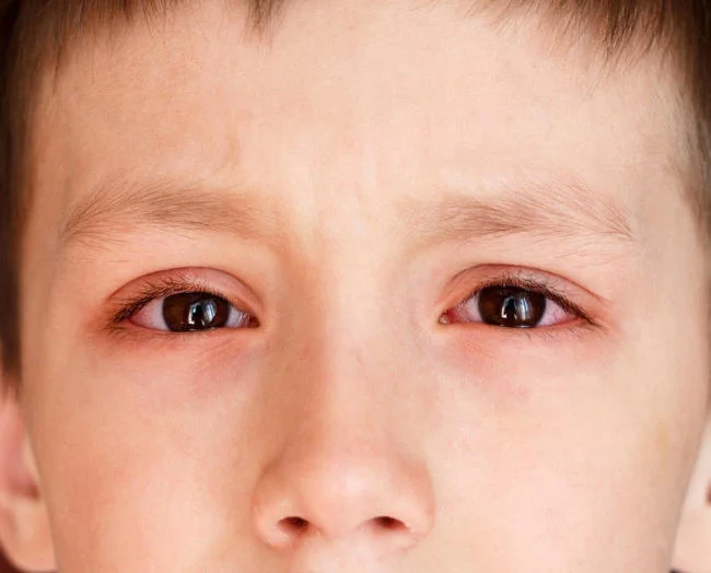 Bệnh viêm kết mạc do virus gây ra