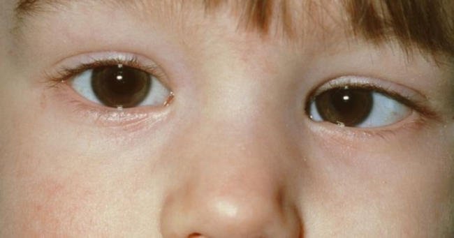 cách chữa mắt lác ở trẻ em tại nhà