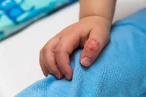 dau hieu cua benh ghe nuoc