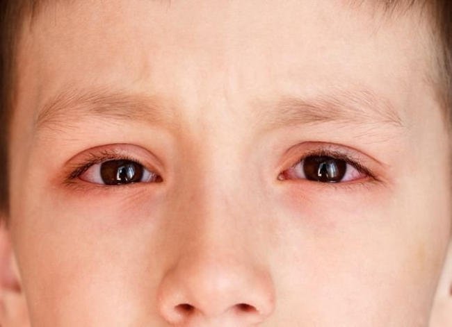 đau mắt đỏ ở trẻ em