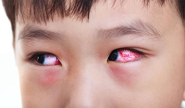 Đau mắt đỏ (Viêm kết mạc dị ứng)
