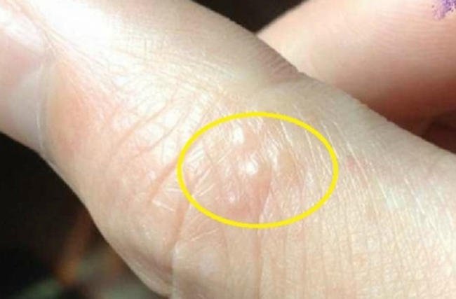 Ghẻ nước ở trẻ