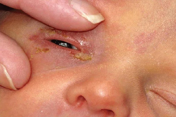 Ghèn vàng hay còn gọi là gỉ mắt