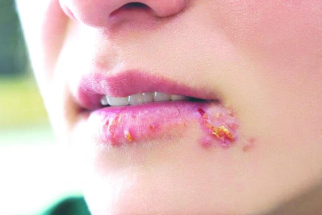 Nhiệt miệng Herpes