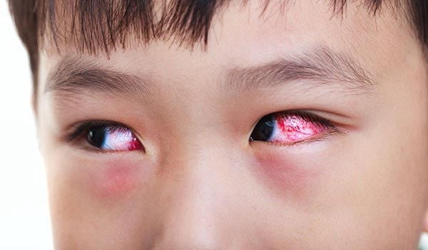 Trẻ dụi mắt có thể do bị bệnh