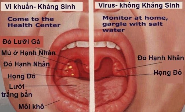 tre bi viem hong do benh tay chan mieng