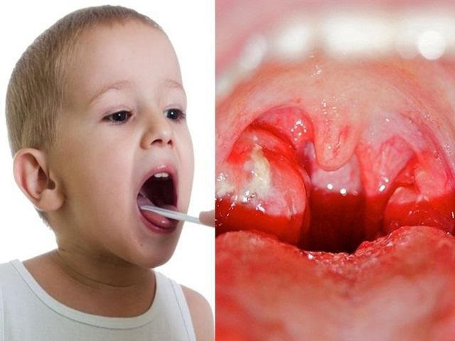Viêm họng ở trẻ là gì?