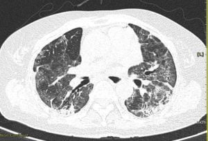 Hội chứng phổi trắng ở trẻ